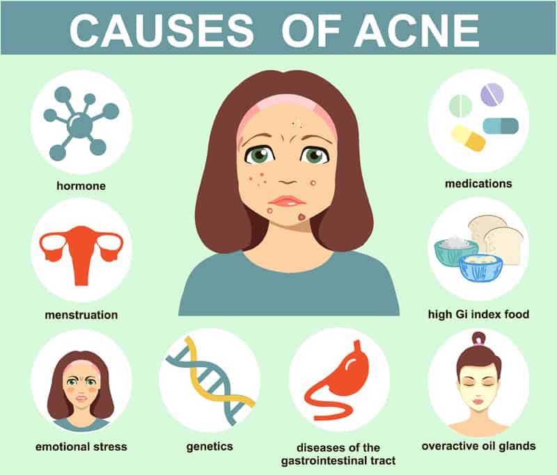 Common Causes of Acne