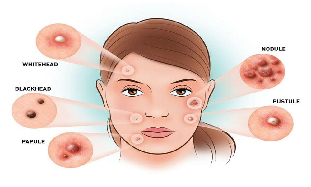 How Hormones Affect Acne