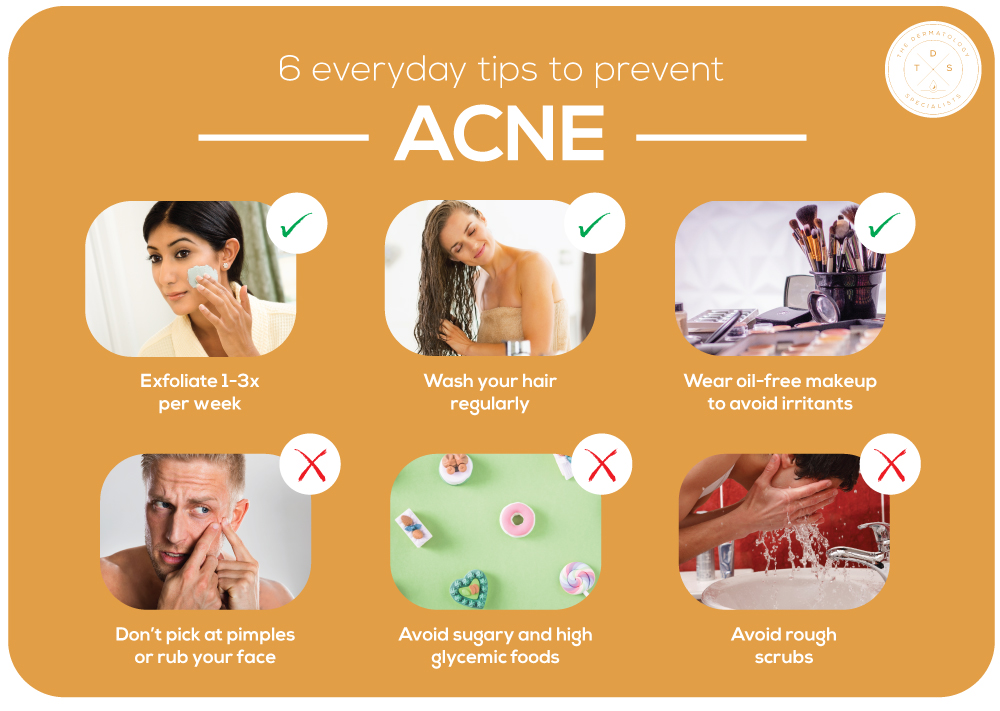 How to Prevent Acne