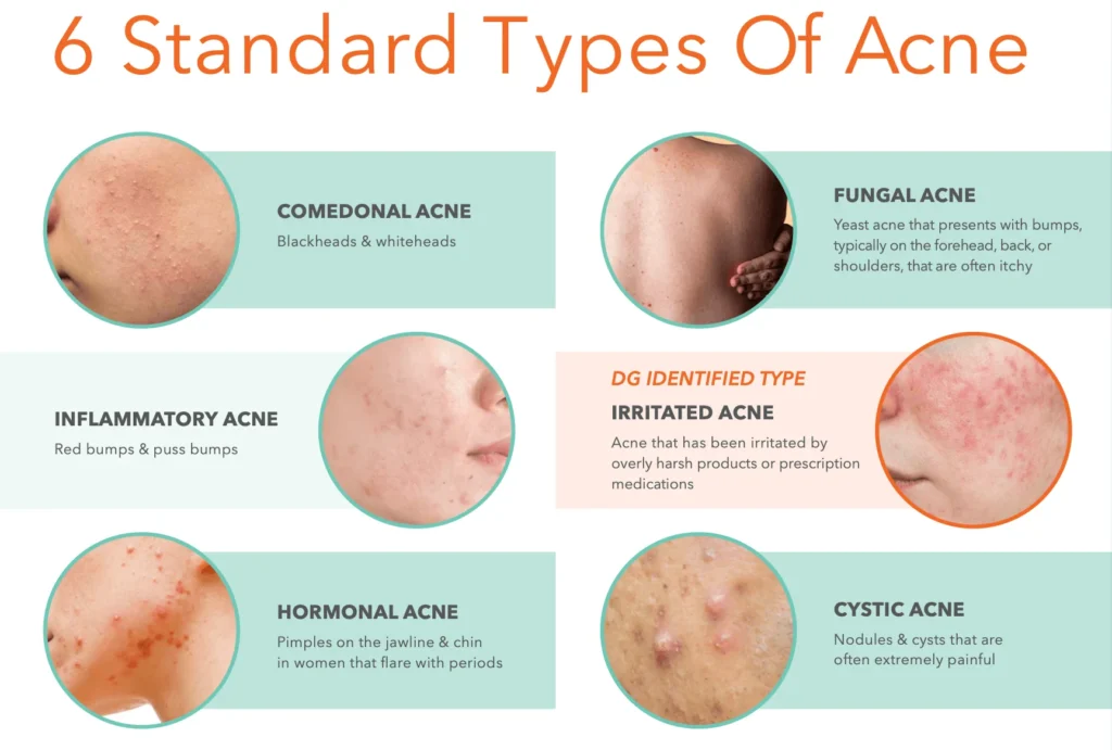 types of acne